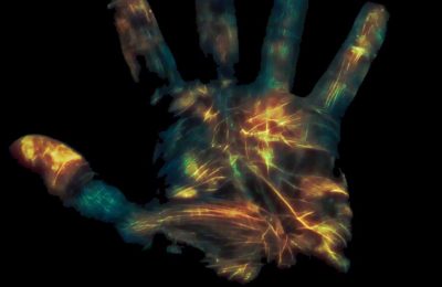 Hand grip strength – a marker of ME/CFS disease severity