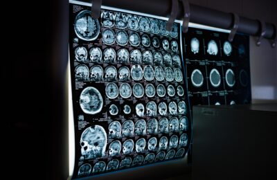ME Research UK-funded study detects brain tissue changes in ME/CFS and long COVID